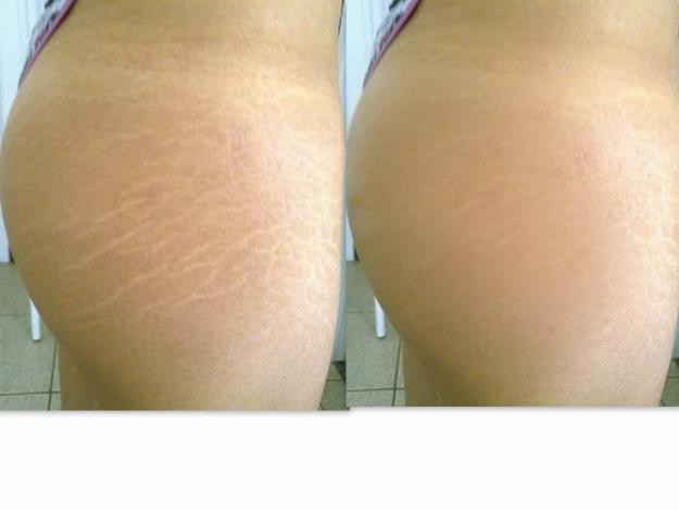 Resultados da aplicação do dermaroller