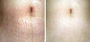 Resultados Dermaroller