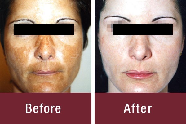 Antes e depois do Cosmelan 2